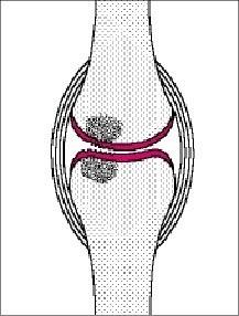 Arthrose Précoce